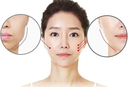 Phẫu Thuật Gọt Cằm Bác Sĩ Lê Hồng Thịnh: Bí Quyết V-Line Hoàn Hảo